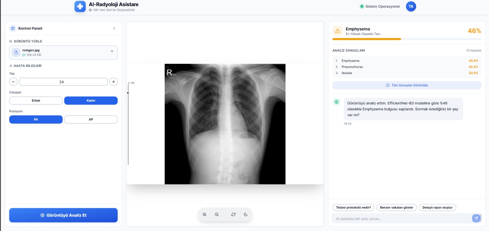 Göğüs Hastalıkları Tahmini